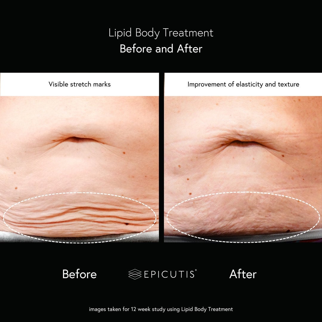 Lipid Body Treatment | Snatch Me HTX - Snatched By Mak Lipid Body Treatment | Snatch Me HTX - Snatched By Mak